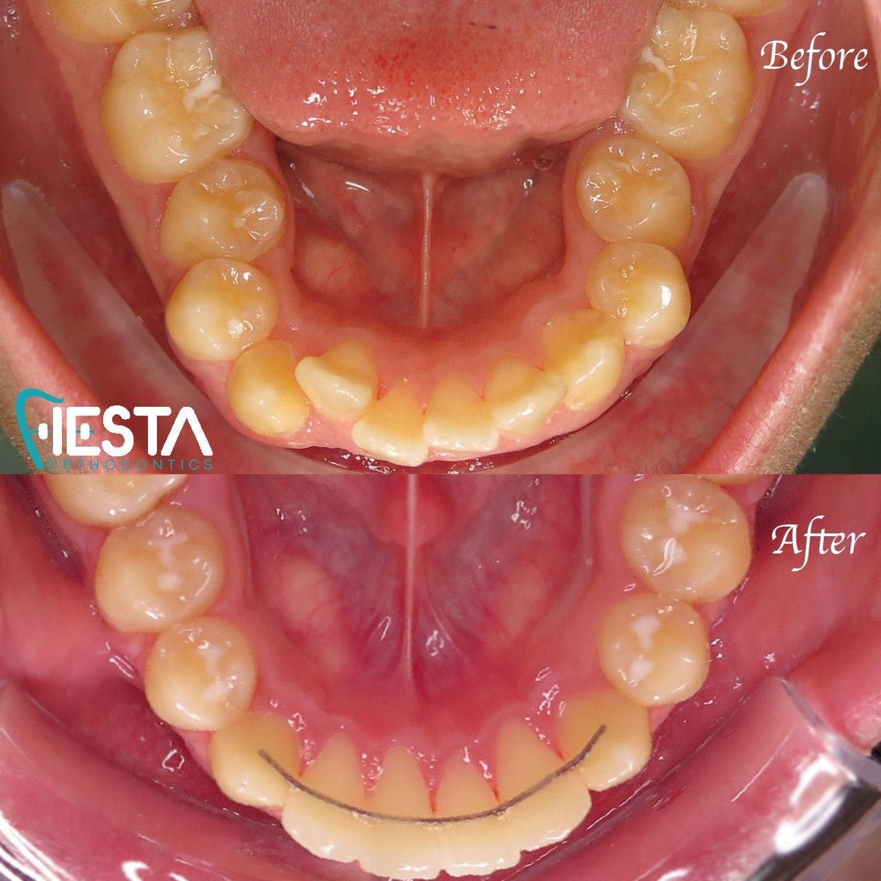 Two dental images from Fiesta Orthodontics display "Before" and "After" views of a person's lower teeth. The "After" image showcases a fixed retainer discreetly placed behind the bottom front teeth in San Antonio, TX before invisalign treatment.