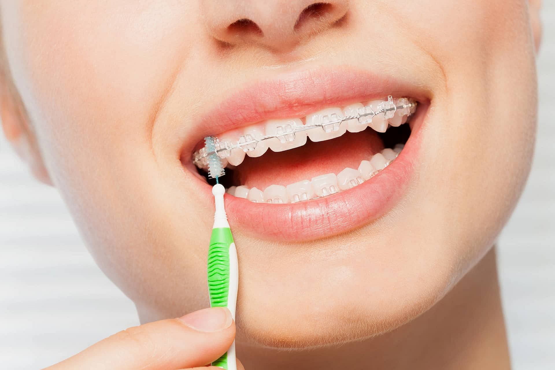 A person with clear braces carefully brushes their teeth using an interdental brush, ensuring every bracket is spotless in San Antonio, TX