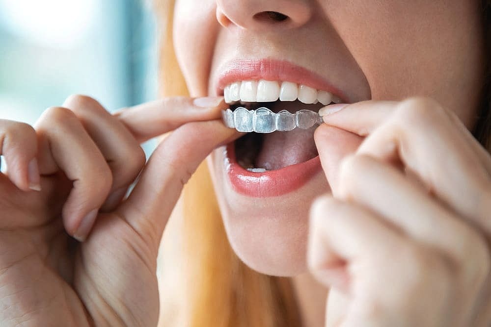 A person carefully inserts a clear dental aligner, choosing Invisalign over traditional braces for its subtlety and comfort highlighting the benefits of Invisalign vs braces in San Antonio, TX