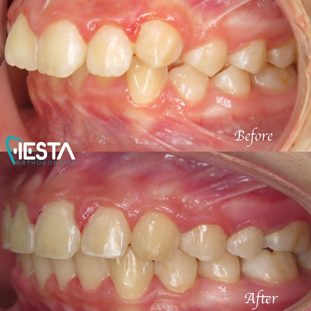 A Fiesta Orthodontics transformation: witness the remarkable before and after comparison showcasing teeth alignment improvements after invisalign treatment in San Antonio, TX.
