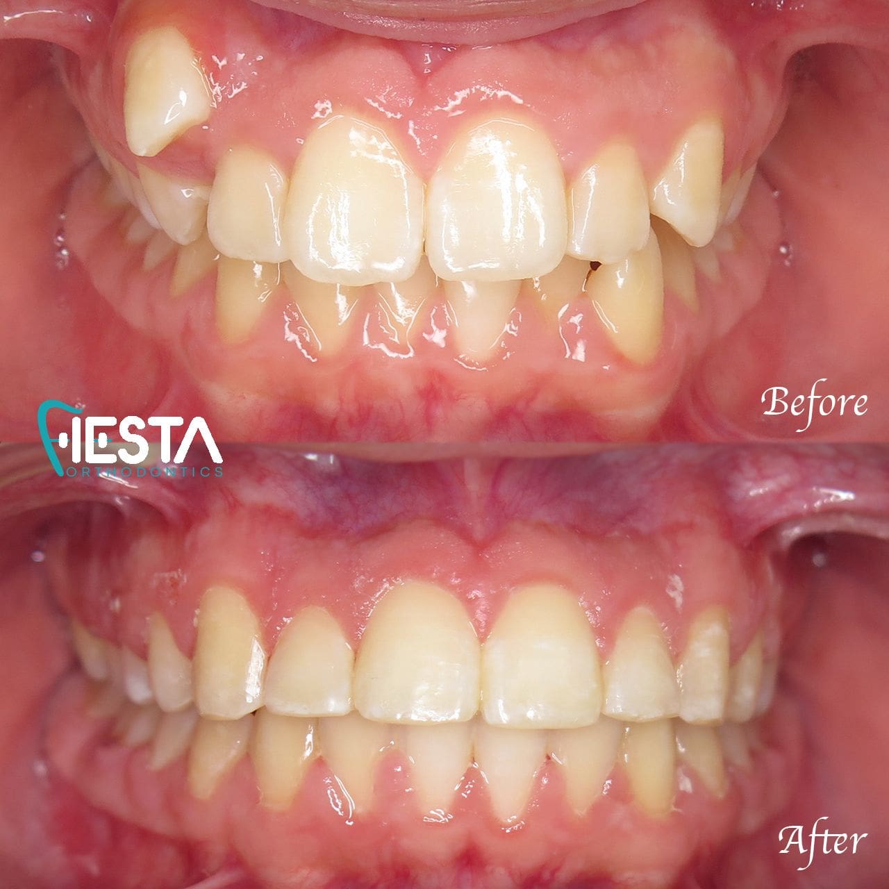 Close-up of teeth displayed before and after treatment at Fiesta Orthodontics. The upper image highlights misaligned teeth, while the lower showcases beautifully straightened results after invisalign in San Antonio, TX.