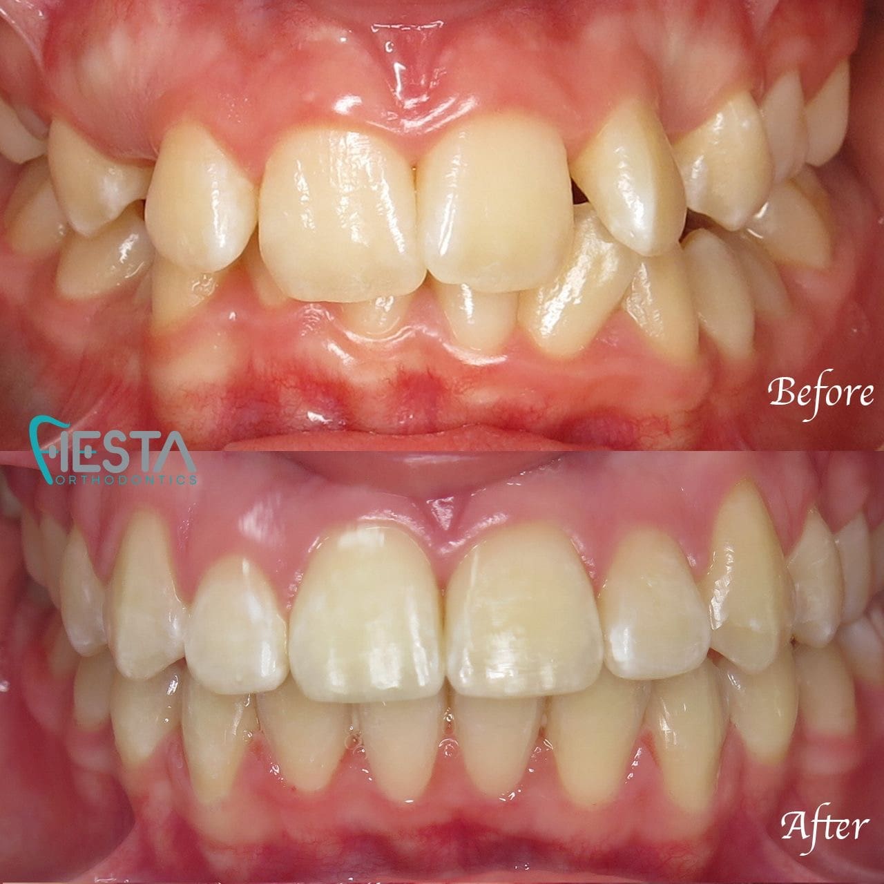 Close-up comparison of teeth before and after orthodontic treatment by Fiesta Orthodontics. The top image reveals misaligned teeth, while the bottom showcases beautifully straightened teeth in San Antonio, TX before invisalign treatment.