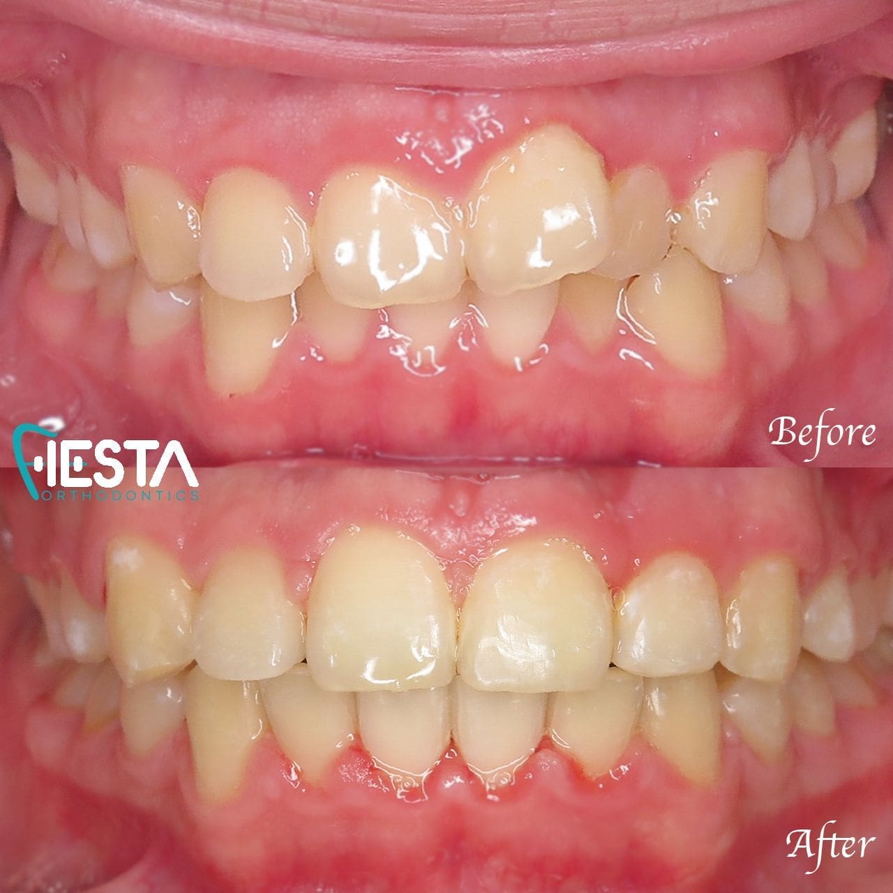 Close-up comparison of teeth before and after orthodontic treatment. The top image shows misaligned teeth, while the bottom reveals the stunning results possible with braces near me in San Antonio, TX, showcasing beautifully straightened smiles.