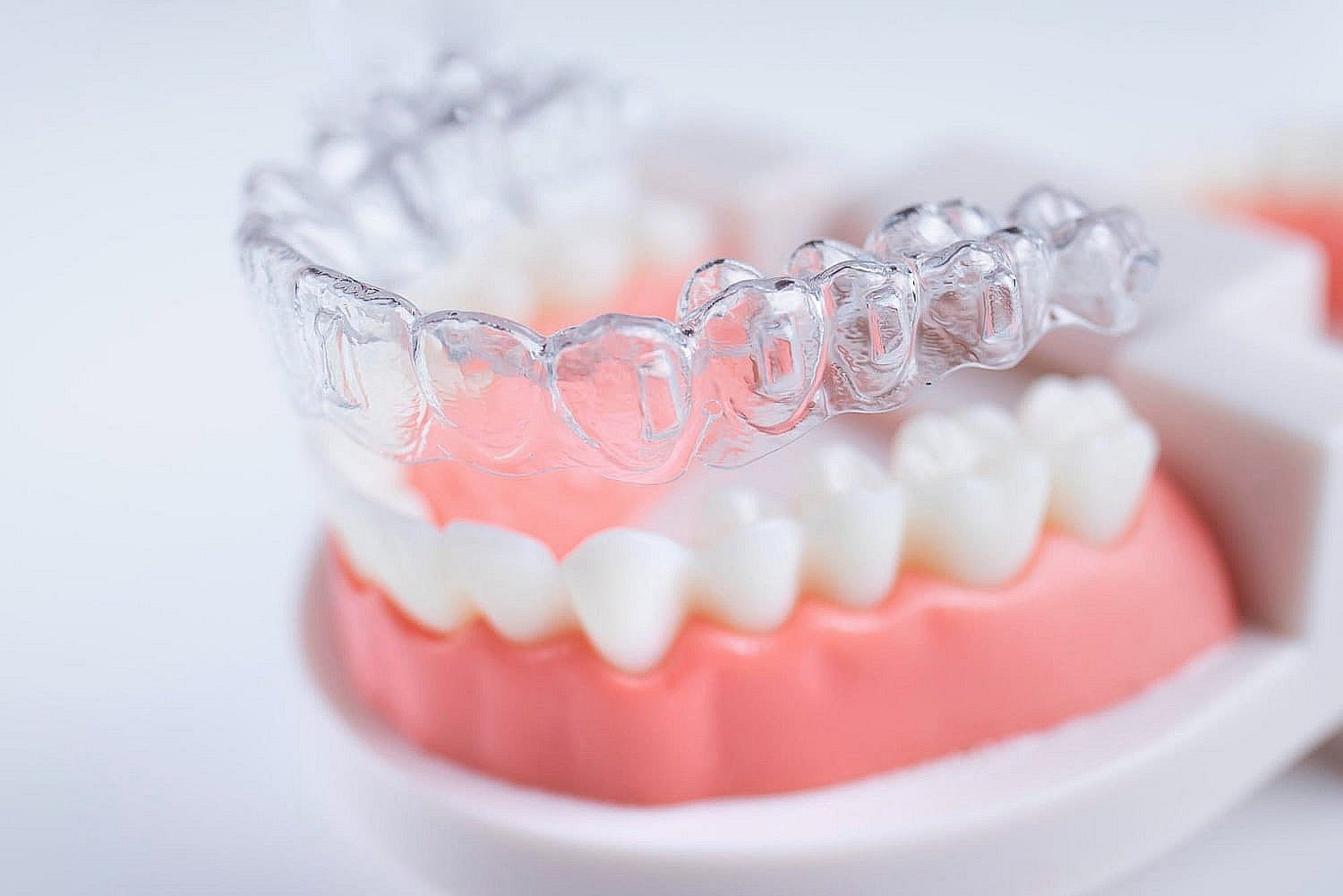 A set of clear dental aligners rests above a model of teeth and gums, illustrating the seamless smile transformation possible with Invisalign. With an Invisalign Payment Plan, achieving perfect alignment has never been more accessible in San Antonio, TX