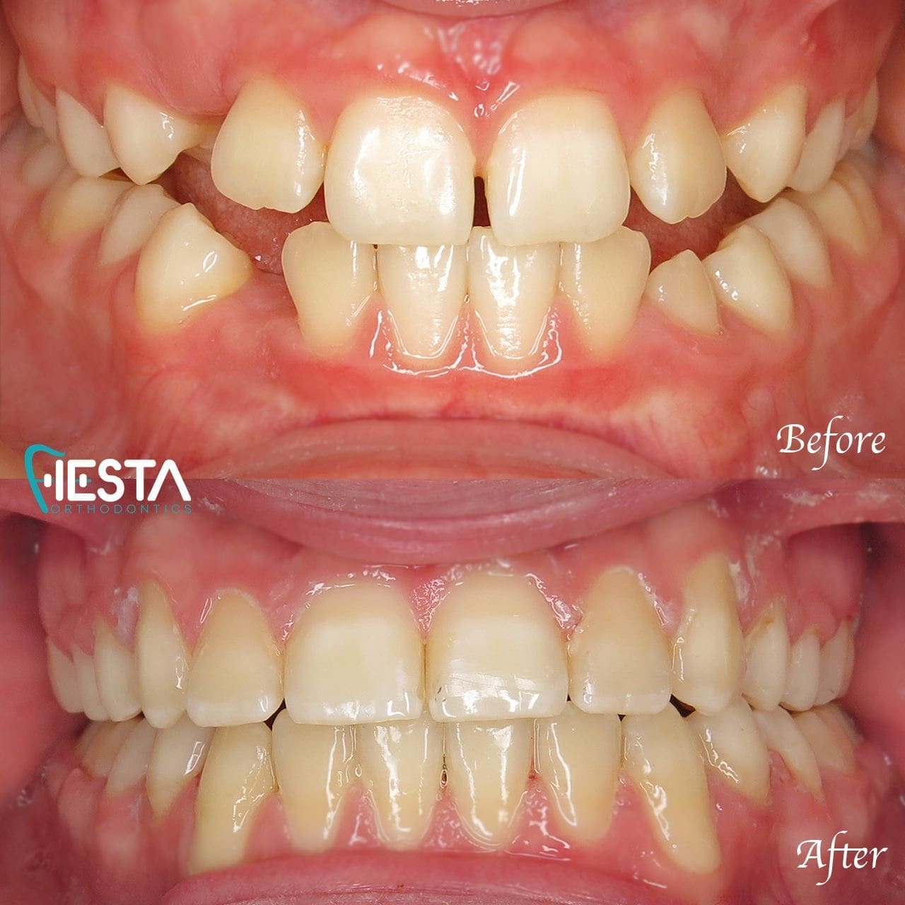 Before and after image showing dental correction with braces near me in San Antonio, TX. The top image displays misaligned and gapped teeth, while the bottom highlights straightened and aligned teeth.