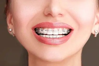 Close-up of a smiling person proudly showing teeth with clear braces in San Antonio, TX
