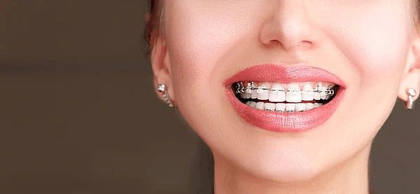 Close-up of a smiling person proudly showing teeth with clear braces near me in San Antonio, TX