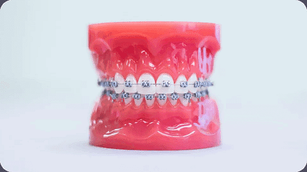 The dental model, featuring teeth adorned with metal braces, stands upright against a plain background in San Antonio, TX