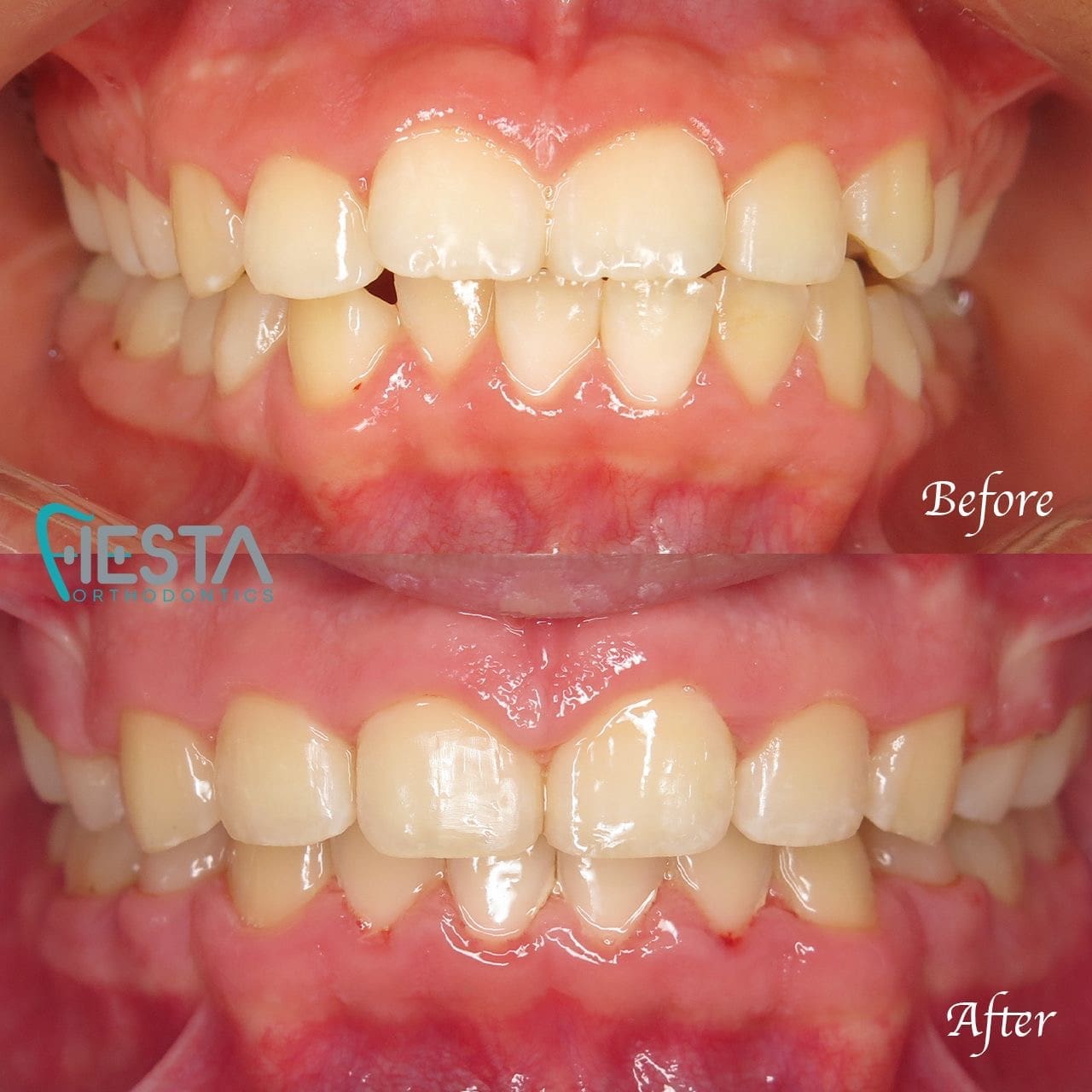 Before and after images reveal the remarkable dental alignment improvements achieved with braces near me in San Antonio, TX, showcasing noticeably straighter teeth in the "After" picture.