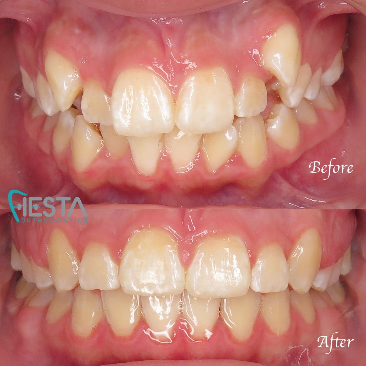 Close-up of two sets of teeth; the top row labeled "Before" reveals crowded, uneven teeth. The bottom row, labeled "After," showcases straighter, well-aligned teeth thanks to braces near me in San Antonio, TX.