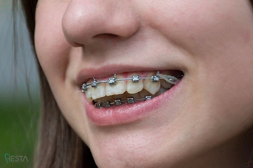 Close-up of a smiling patient showing metal braces on teeth – braces for overbite in San Antonio, TX.