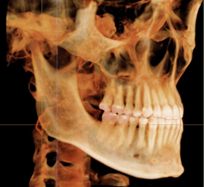 Dr. Fateh Arslan and Dr. Ayla Idilbi: Orthodontist in East San Antonio TX A 3D scan displays a human skull’s bone and teeth structure at Fiesta Orthodontics in East San Antonio, TX.