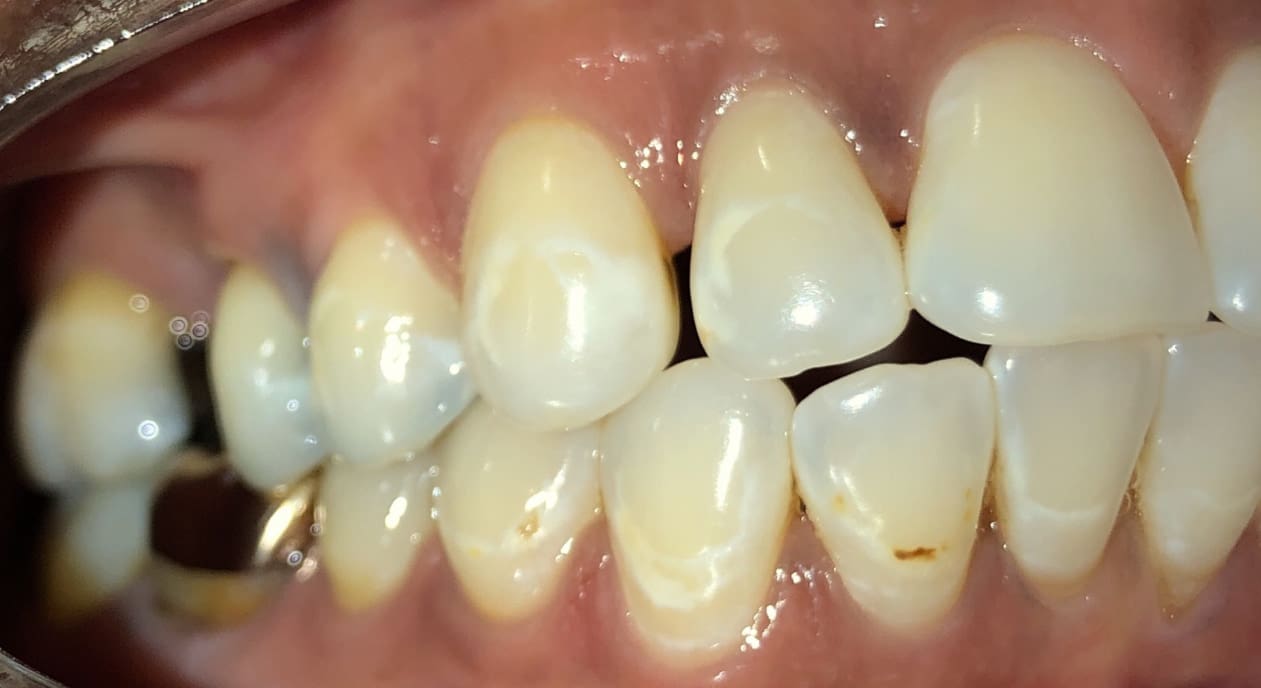 Teeth with mild plaque, white spots, and discoloration near the gums, as seen at Fiesta Orthodontics in East San Antonio, TX.