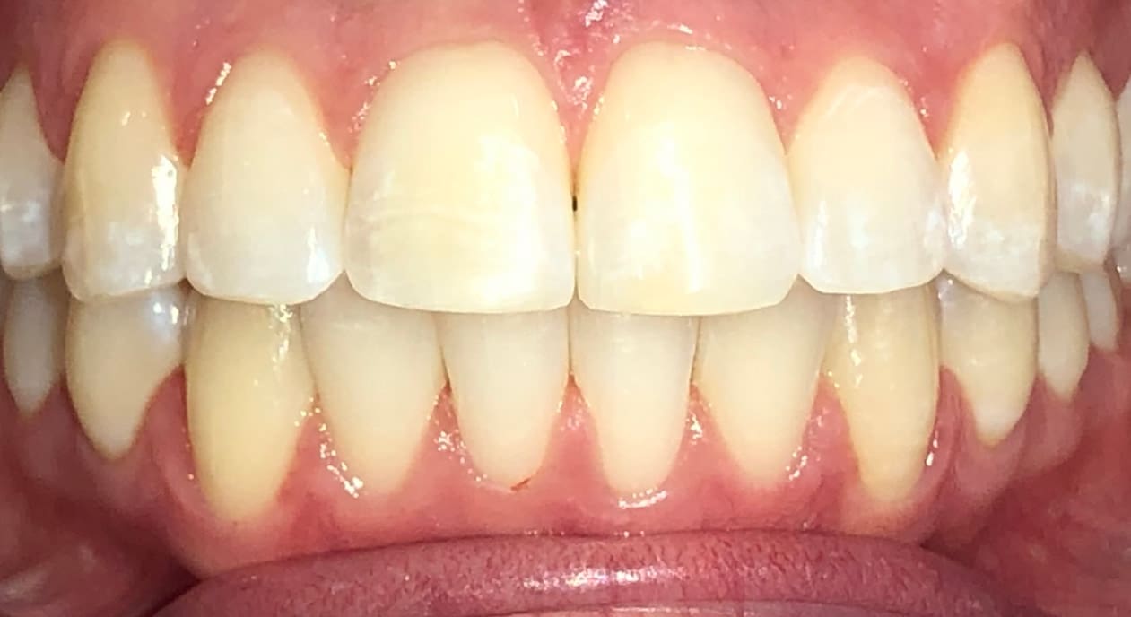 Improved lower crowding shown in close-up of clean, aligned teeth and gums at Fiesta Orthodontics in West San Antonio, TX.