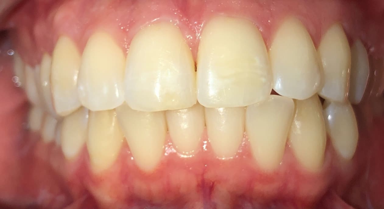 Lower teeth crowding before treatment, healthy gums and front teeth visible at Fiesta Orthodontics in West San Antonio, TX.