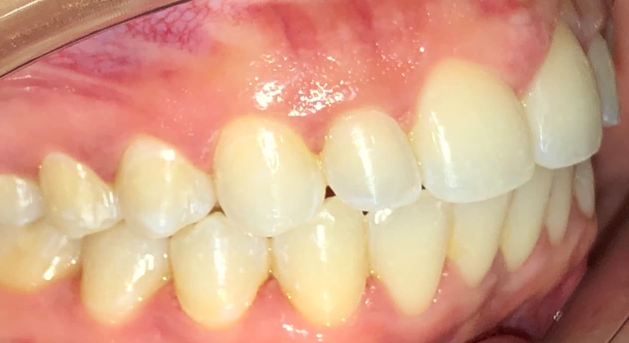 At Fiesta Orthodontics in West San Antonio, TX, close-up of teeth shows slight crowding, openbite post-treatment, and mild yellow staining near gums.