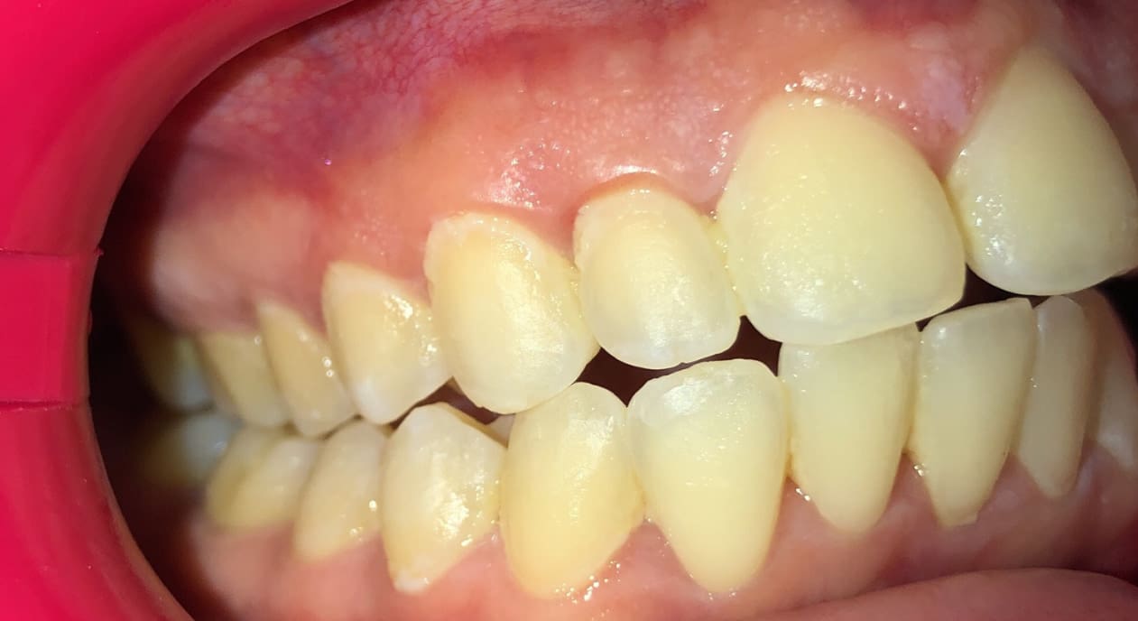 Close-up of a mouth with overbite and mild crowding, showing dental alignment before treatment at Fiesta Orthodontics in West San Antonio, TX.