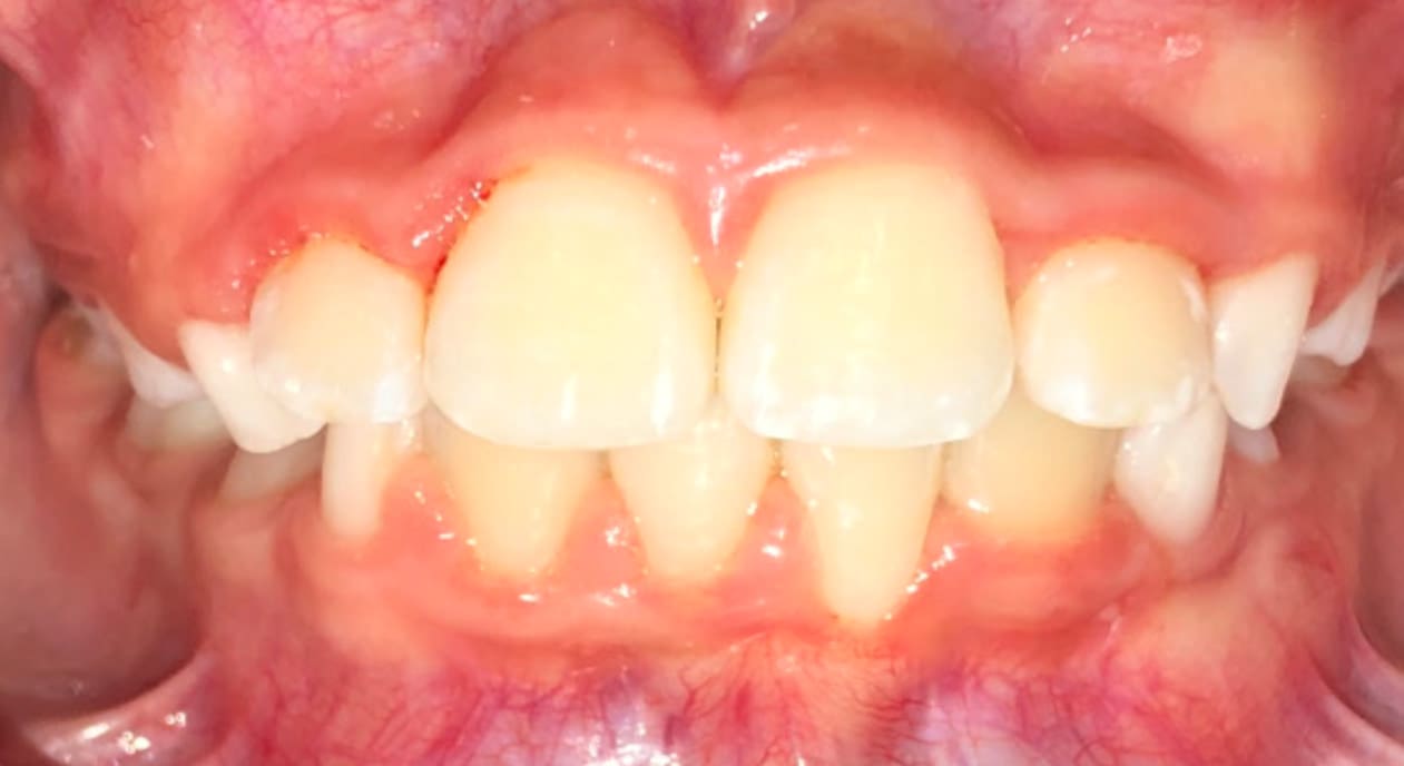 After orthodontic treatment at Fiesta Orthodontics in West San Antonio, TX, teeth show misalignment and openbite.