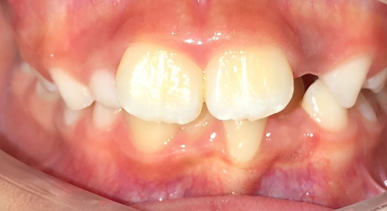 Dental crowding, misaligned teeth, and openbite before treatment at Fiesta Orthodontics in West San Antonio, TX.