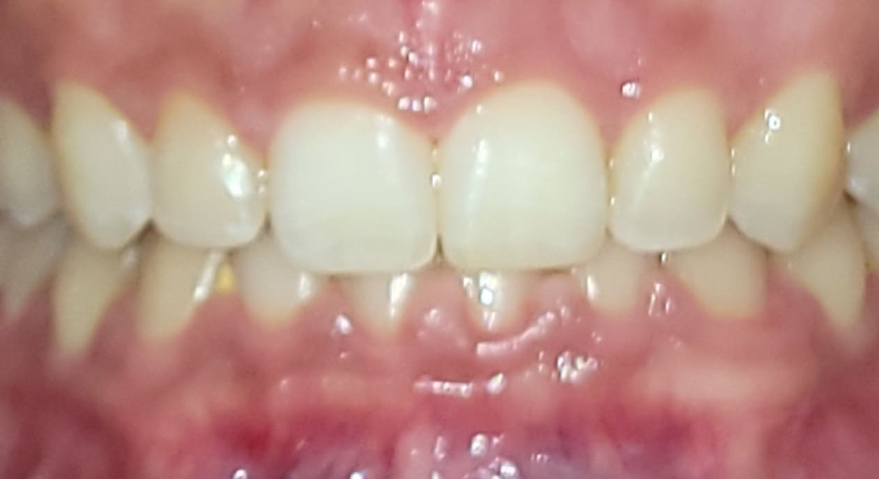 A close-up of aligned teeth with visible gums and no dental appliances, representing Fiesta Orthodontics in East San Antonio, TX.