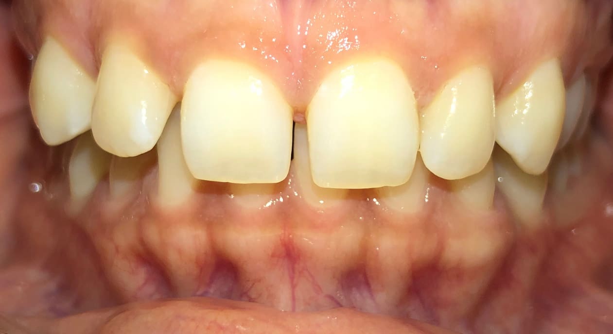 Before treatment at Fiesta Orthodontics in East San Antonio, TX: close-up of teeth with gaps and misalignment.