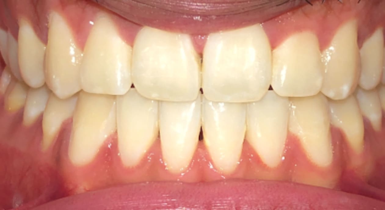 Showing clean, evenly spaced teeth with a slight overbite after underbite treatment at Fiesta Orthodontics in East San Antonio, TX.