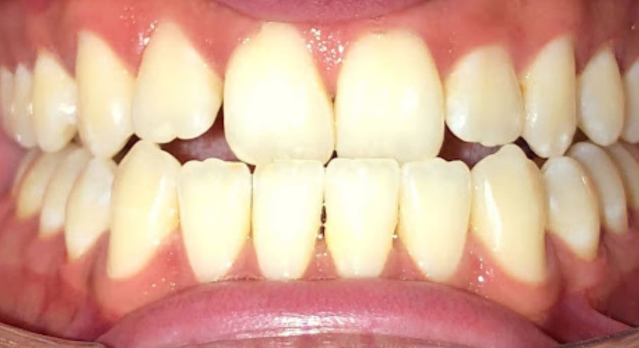 Close-up of mild yellowing and crowding with an underbite before treatment at Fiesta Orthodontics in East San Antonio, TX.